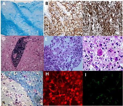 Central nervous system tumefactive demyelinating lesions: Risk factors of relapse and follow-up observations